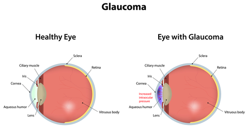 Brief Review On Classification Of Glaucoma