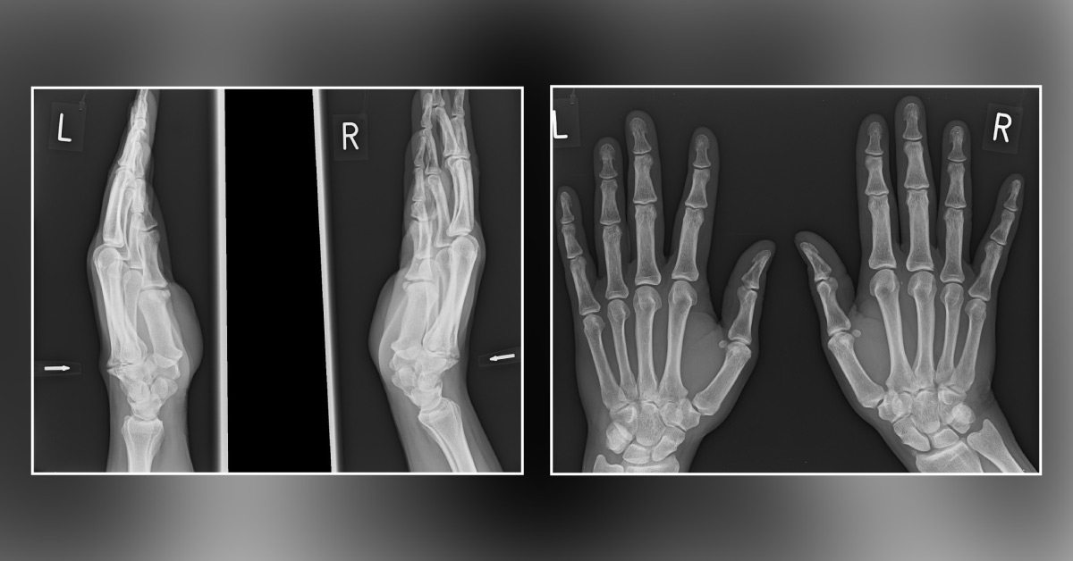 An Old Lady With Bony Prominences of Hand
