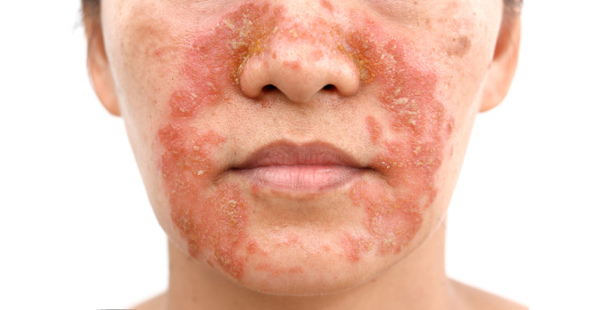 Brief On Topical Corticosteroids Abuse