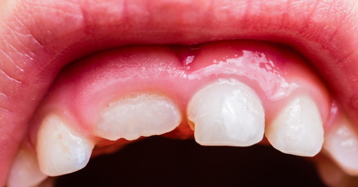 Diagnose This Man with Swollen Gums