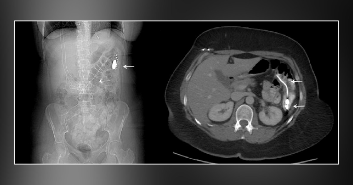 An Unusual Case of Abdominal Pain