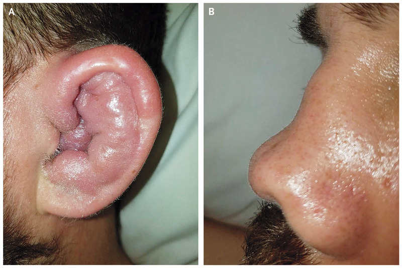 Case Of Swelling In Left Ear