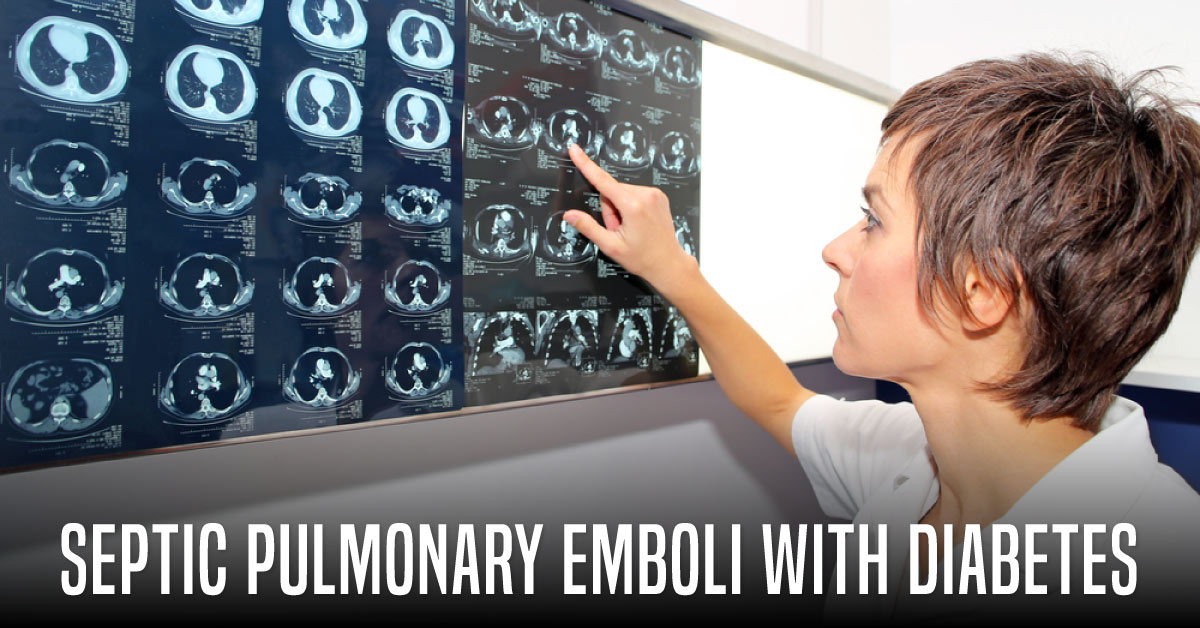 Diabetes Mellitus Association With Septic Pulmonary Emboli Or Pulmonary Metastasis