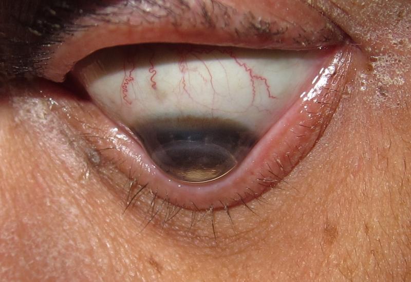 Five Cardinal Features Of Keratoconus