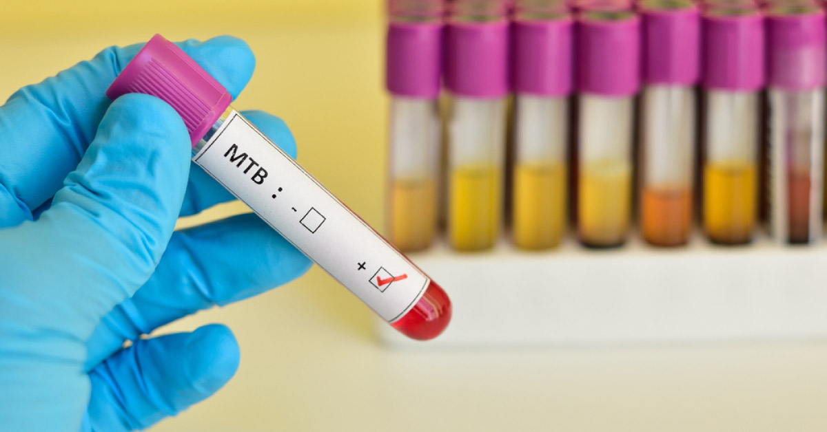 AIIMS-Led Team Develops Sensitive Diagnostic Tests For TB