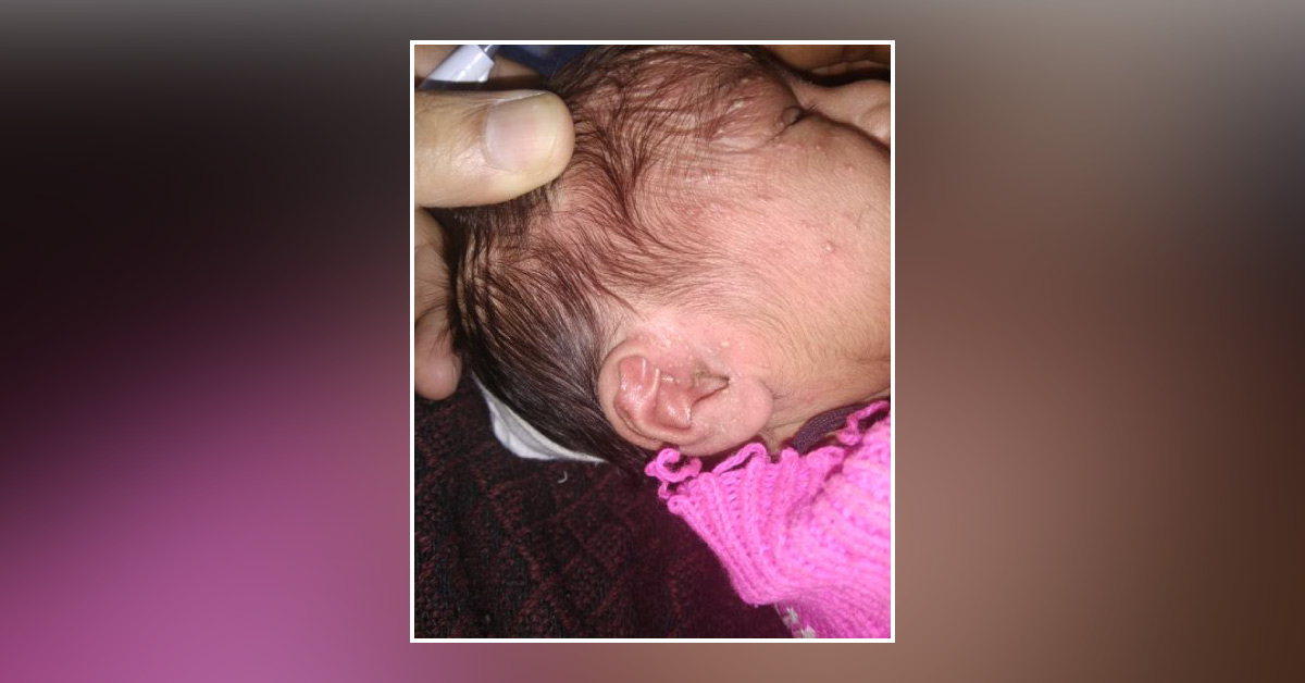 Papular Rash On Face Of A Newborn