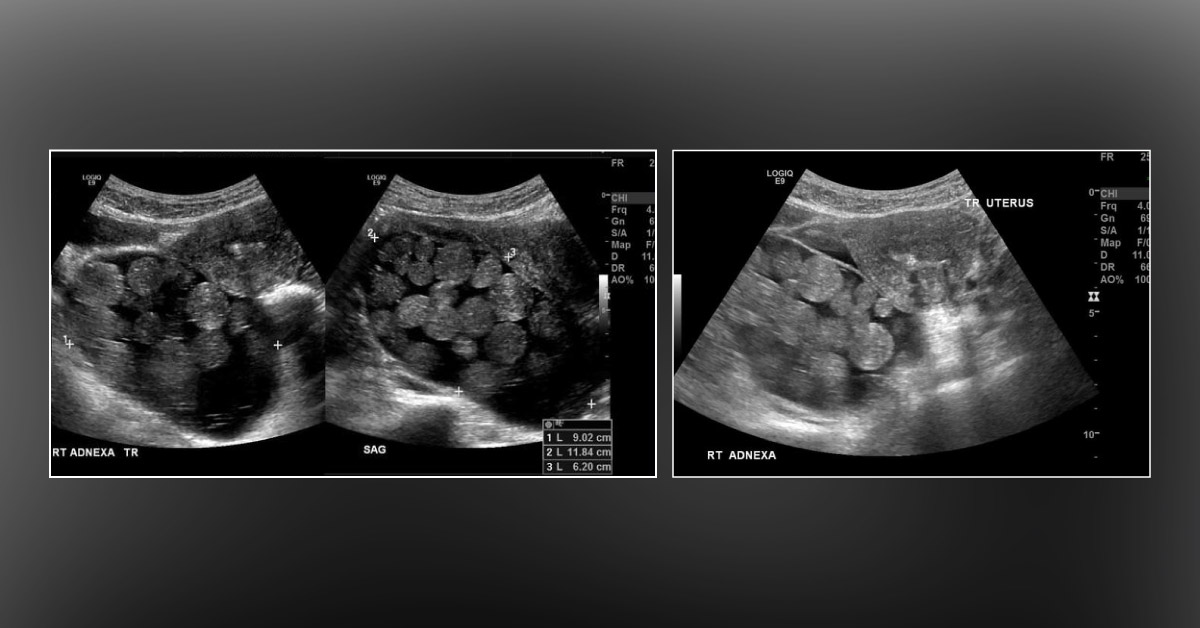 What is Evident from This Ultrasound?