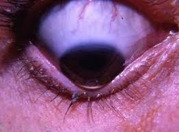Discuss Diagnosis And Treatment