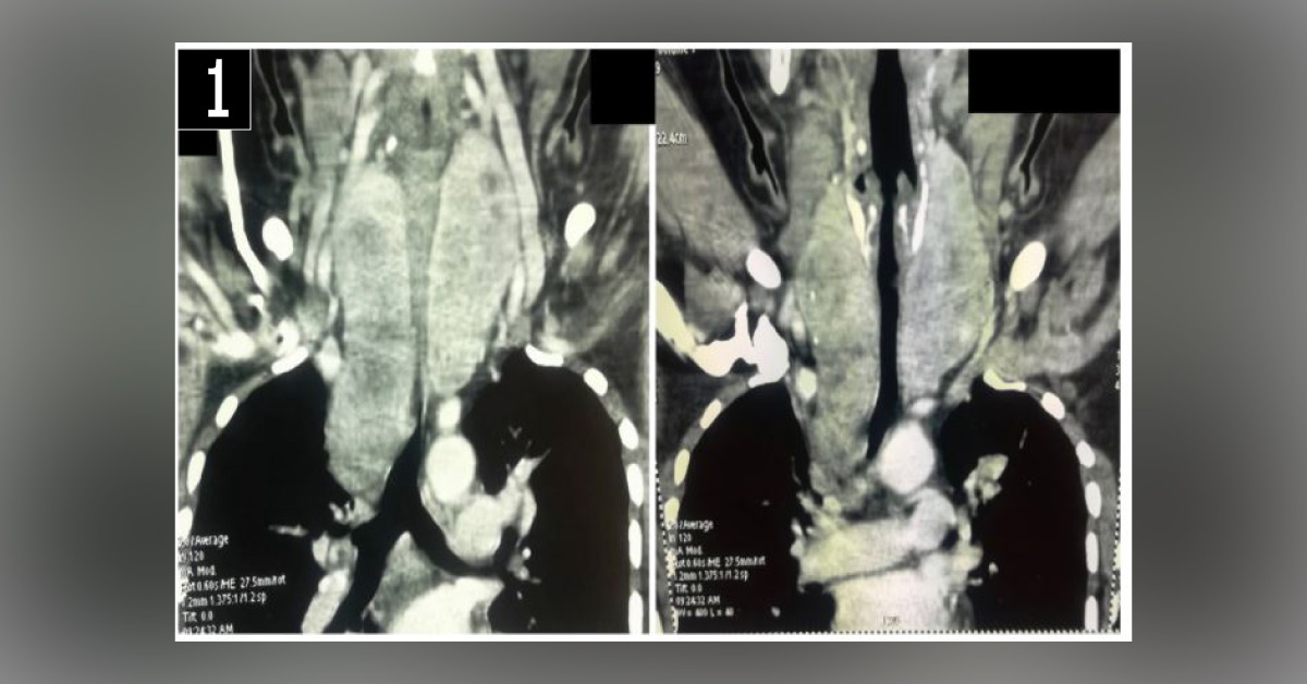 Diagnose This Case With Pre-Existing Goiter