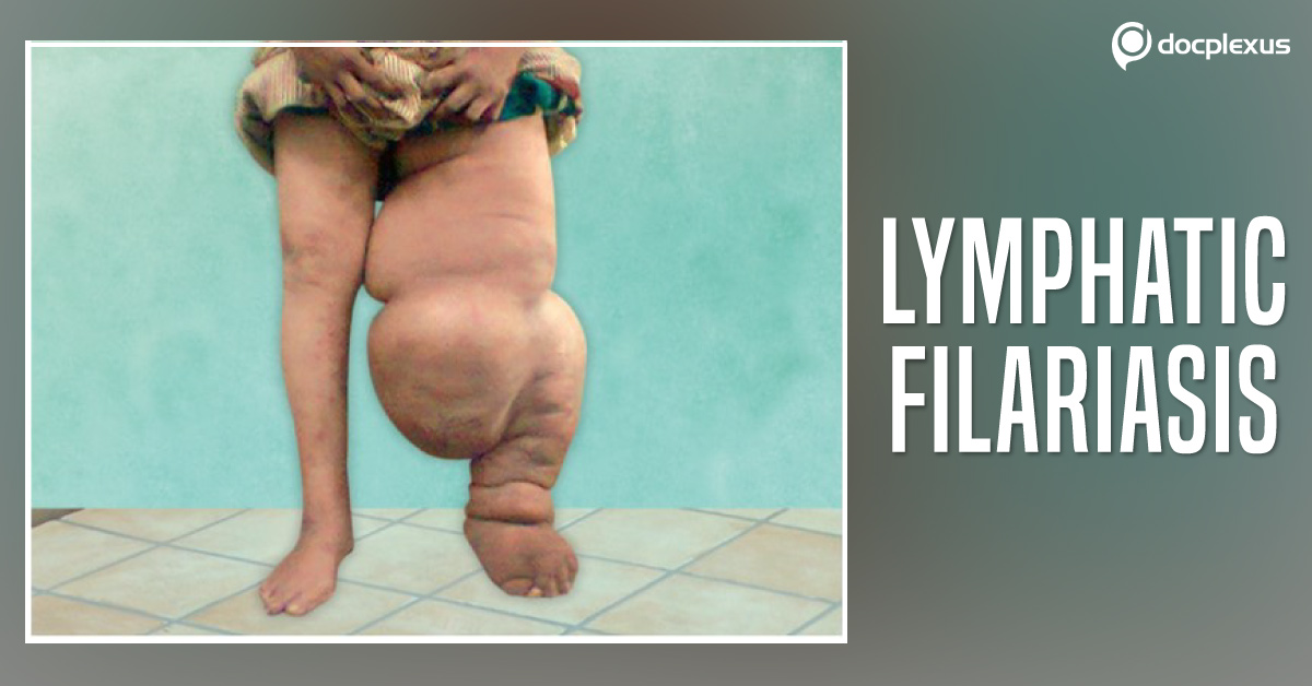 How To Prevent Lymphatic Filariasis?