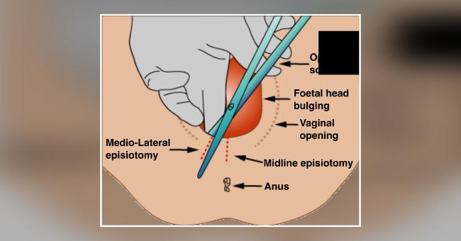 Pain Complications And Discomfort Of Episiotomy Versus Pain Complications And Discomfort Of Cesarean Section (Elective  Or Emergency)