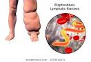 Triple-Drug Therapy Superior To Two Drugs For Treating Lymphatic Filariasis