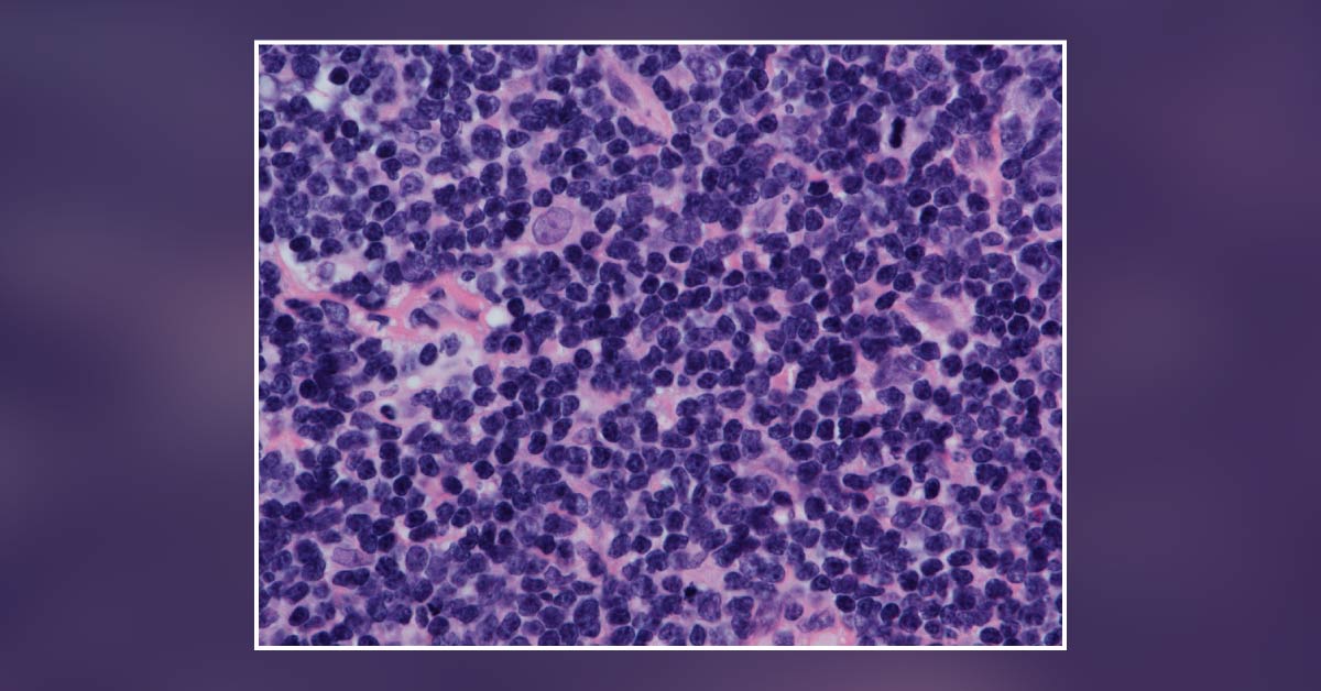Experiencing Mantle Cell Lymphoma