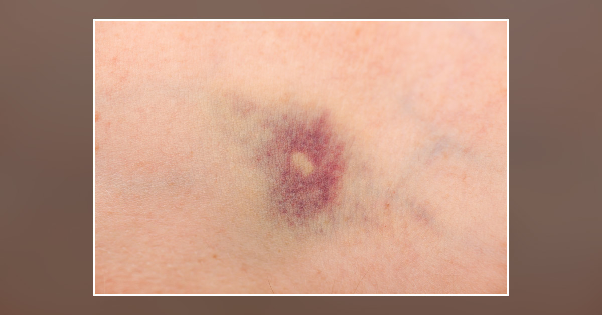 Case of a Woman with TPP and Multiple Comorbidities