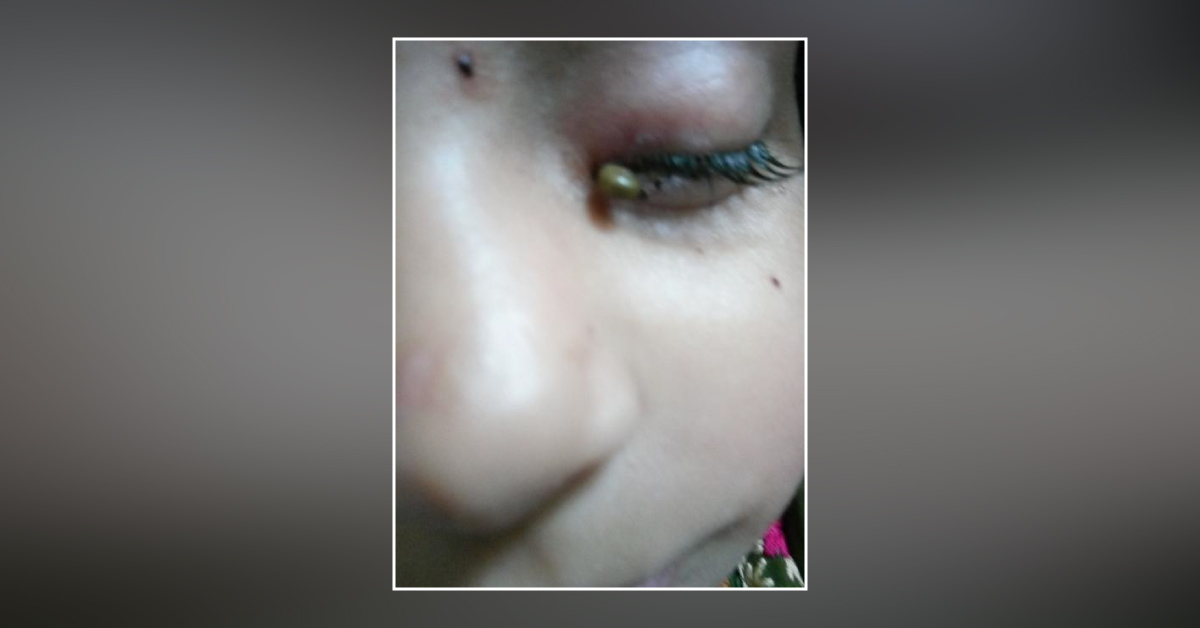 Manage The Swelling Upper Eyelid Left Eye