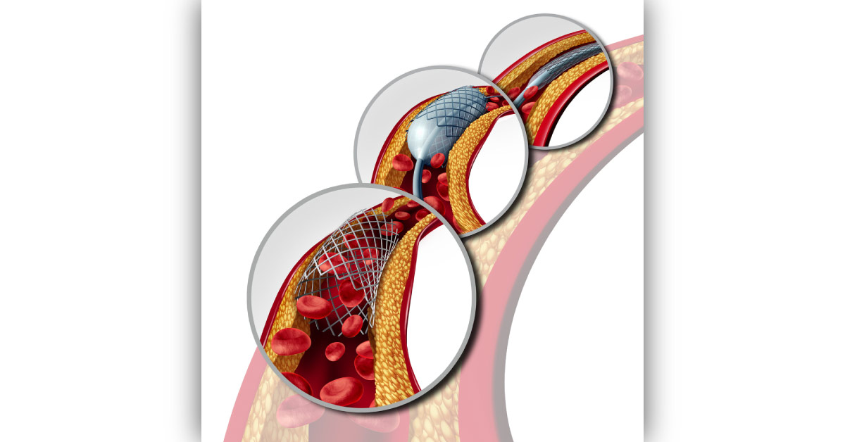 Optimization and audit of radiation dose during percutaneous transluminal coronary angioplasty