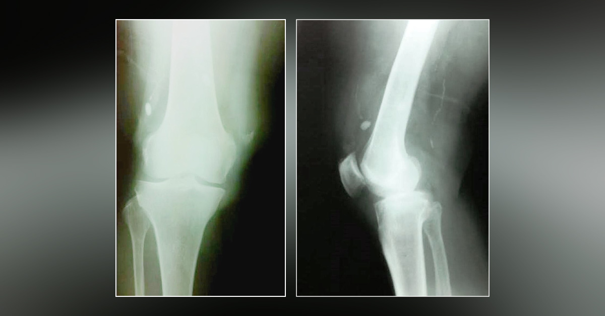 Case of a Man with Chronic Pain in the Right Thigh