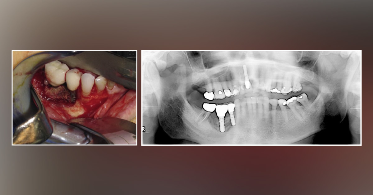Diagnose the Dental Implant Failure Case