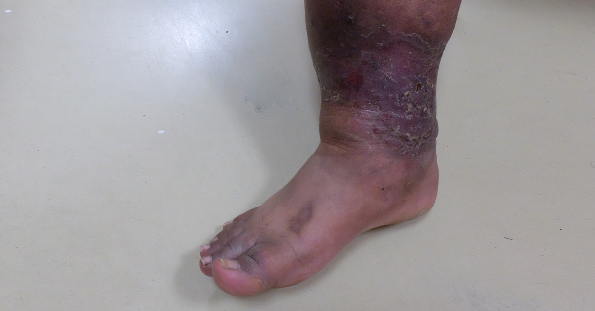 A Case of Painful, Reddened Lower Legs
