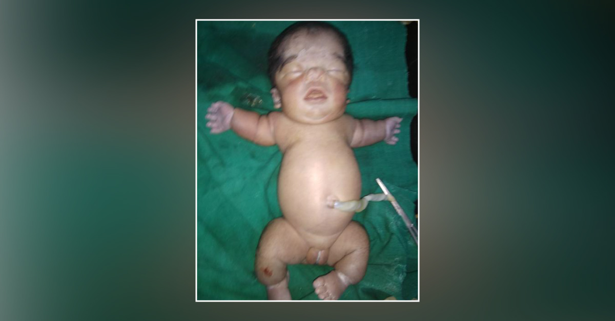 Newborn With Dysmorphism
