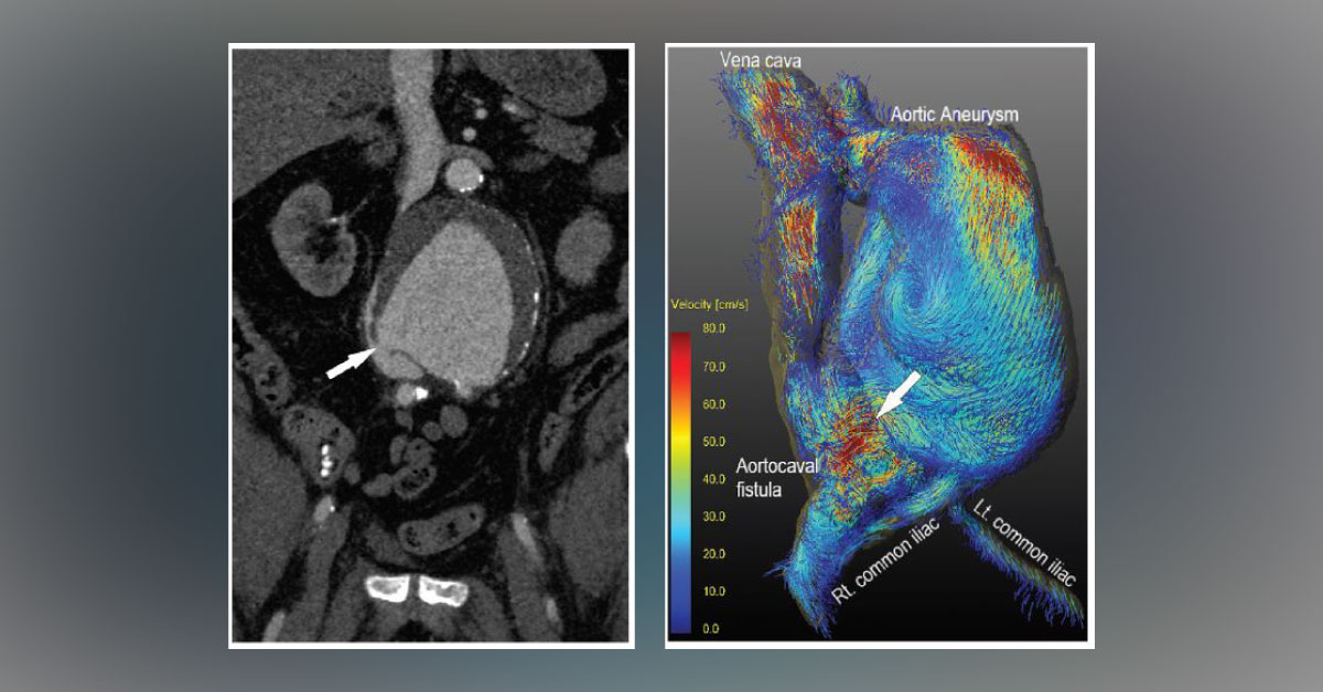 A Case of Sudden Pain in Gluteal Muscles