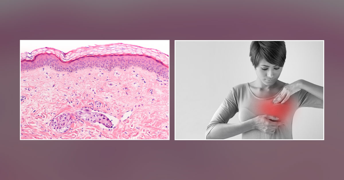 Inflammatory Breast Cancer: A Single Centre Analysis