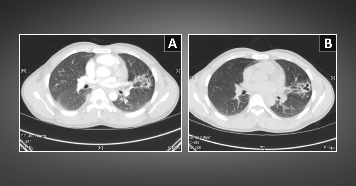 Case of a Man with Non-Resolving Cavitary Lung Lesion