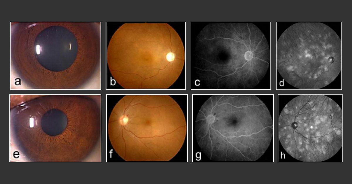 Identify the Ophthalmic Complication