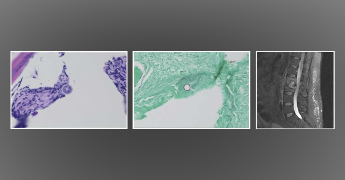 Diagnose This Rare Infection