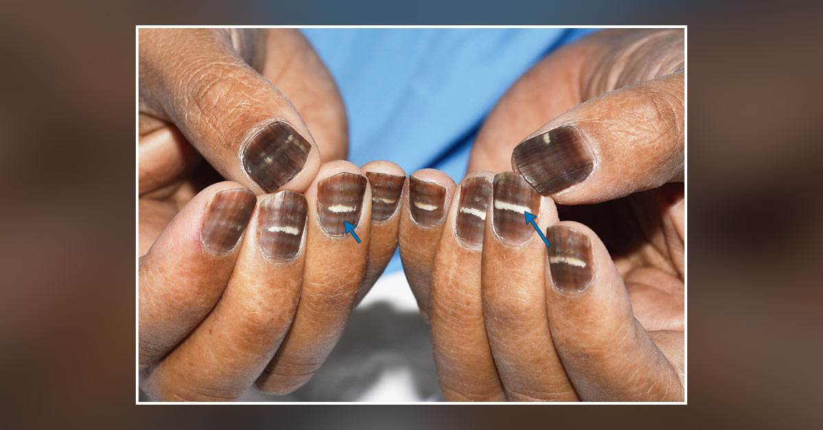 Case of a Man with Changes in Fingernails