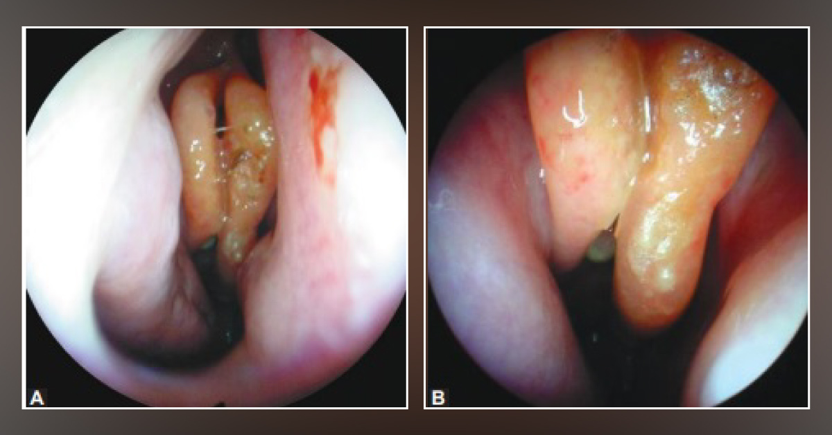 What Does the Endoscopy Reveal?