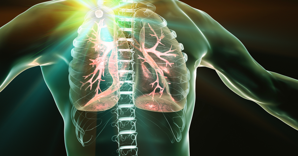 Study: Pulmonary Tuberculosis Can Be Cured With Shorter Treatment