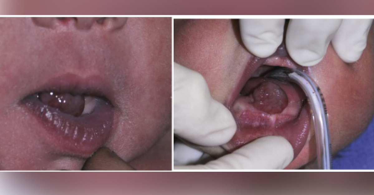 Diagnose the Condition in This Newborn