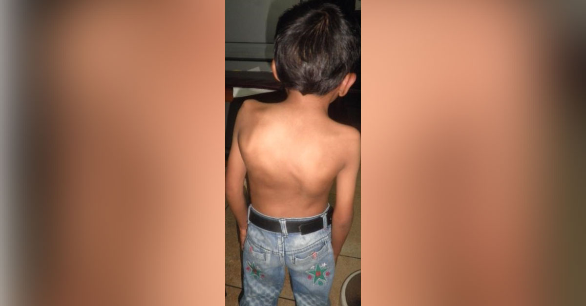 Case Of Noonan's Syndrome