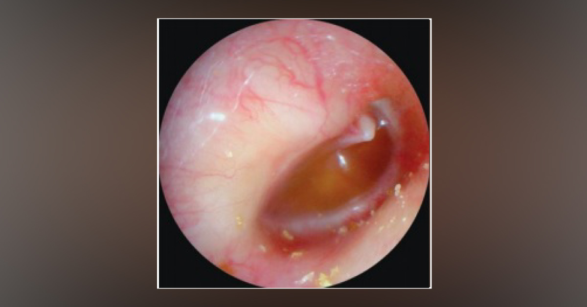 Evaluate The Otoendoscopic Examination