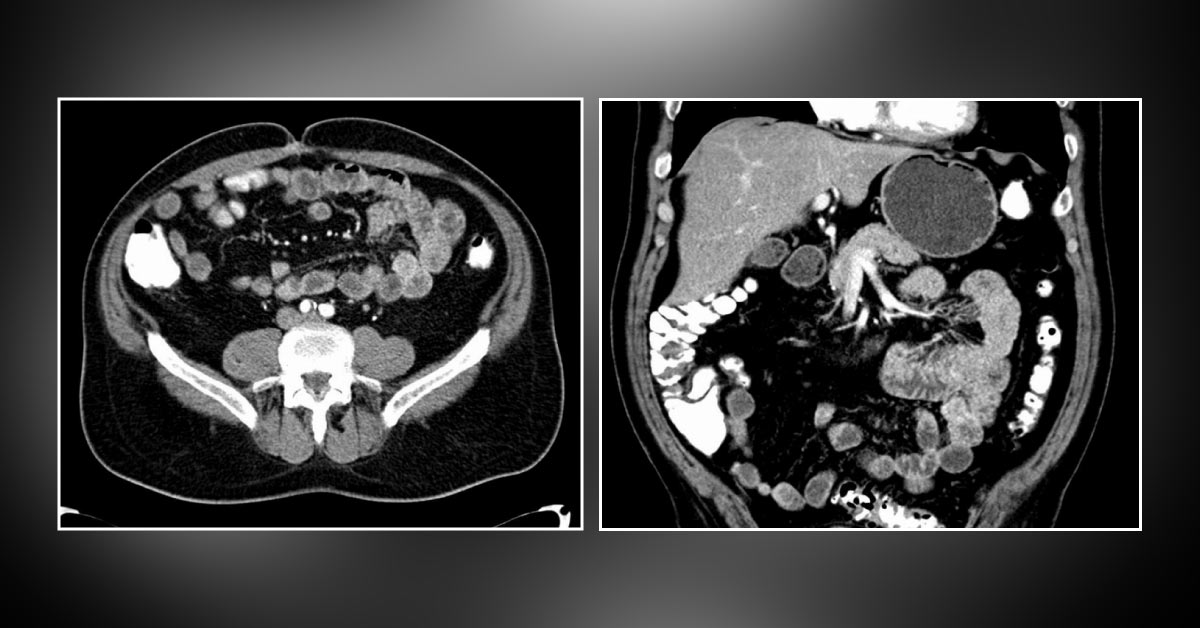 Diagnose This Case of Abdominal Pain