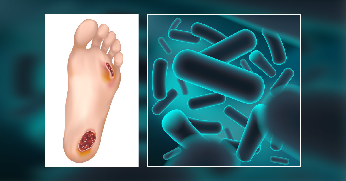 Can Probiotics Heal Diabetic Ulcers?