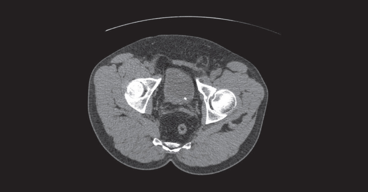 Left Loin Pain in a Female