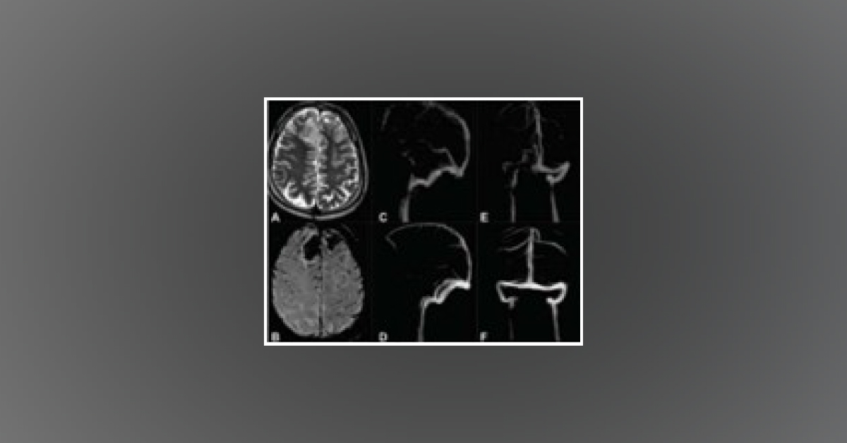 Oral Rivaroxaban for Cerebral Venous Thrombosis