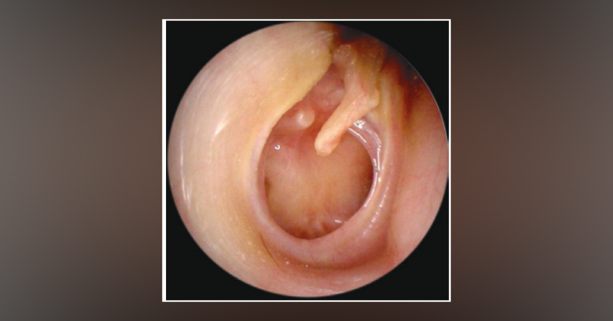 Reduced Hearing in a Middle-aged Lady