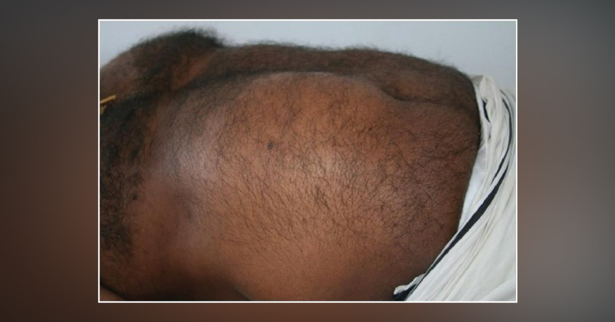 Diabetic Neuropathy: A Rare Case Presentation