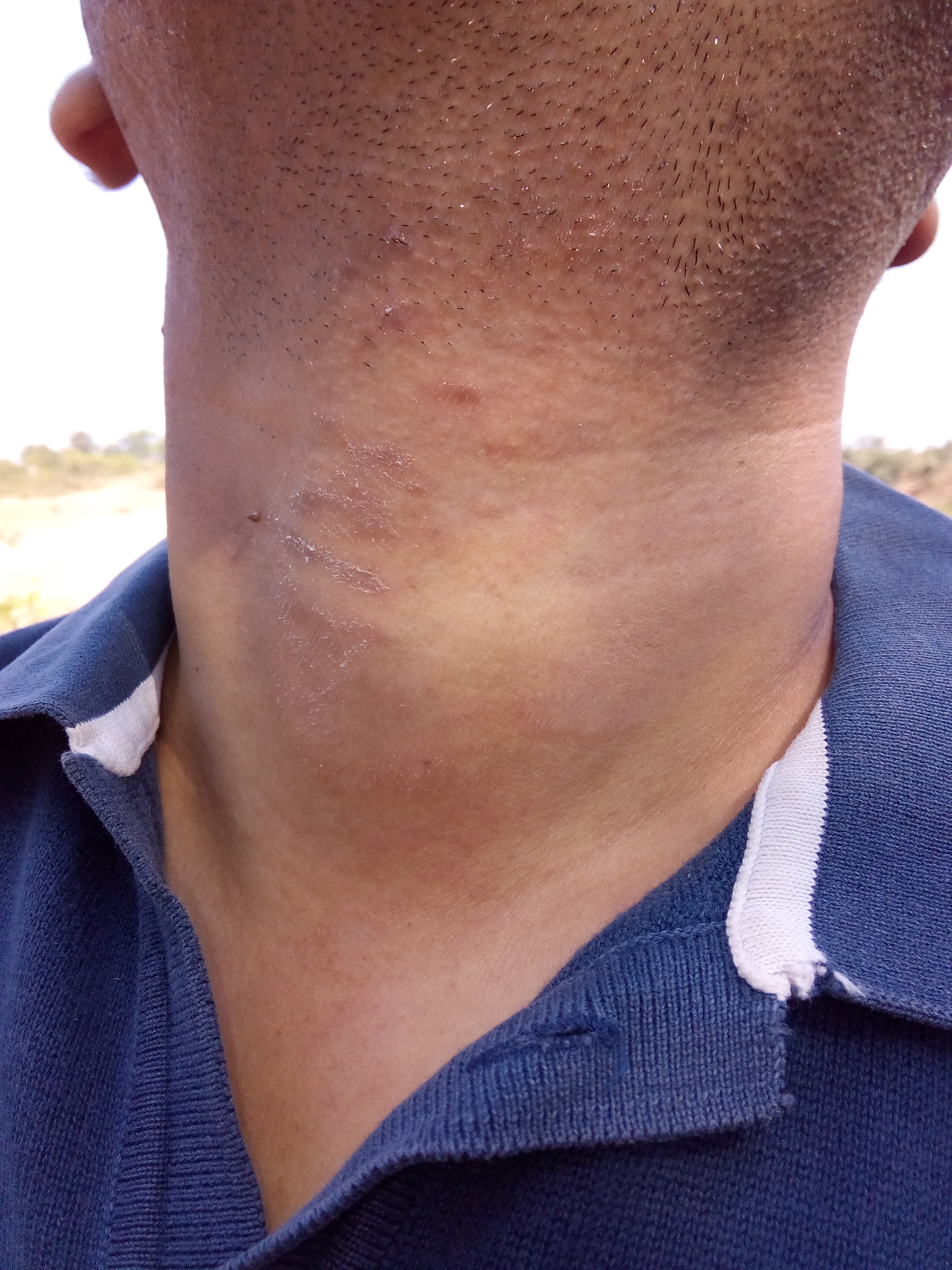 Case Of Skin Disorder