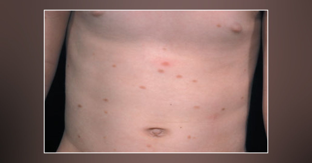 A Toddler with Brown Patches Which Urticate