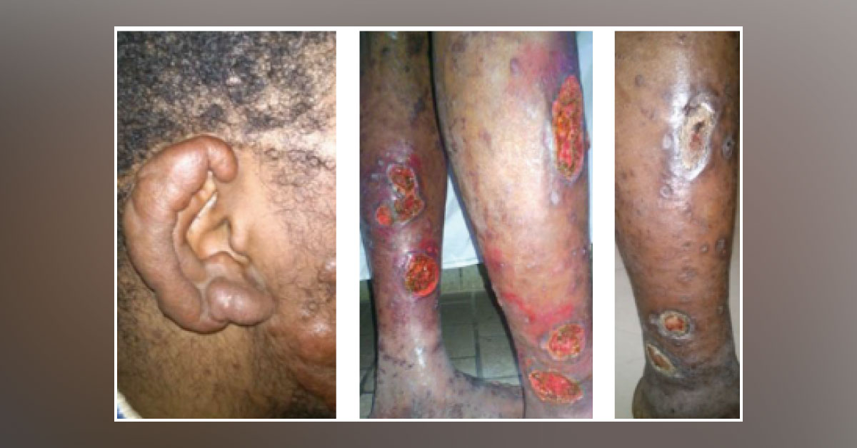 Diagnose These Non-healing Skin Ulcers