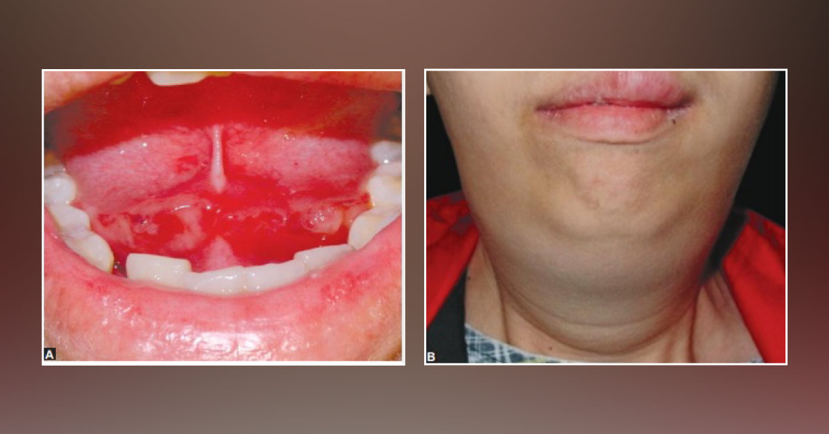 Fever and Swollen Neck in a Woman – What's Your Diagnosis for Her?