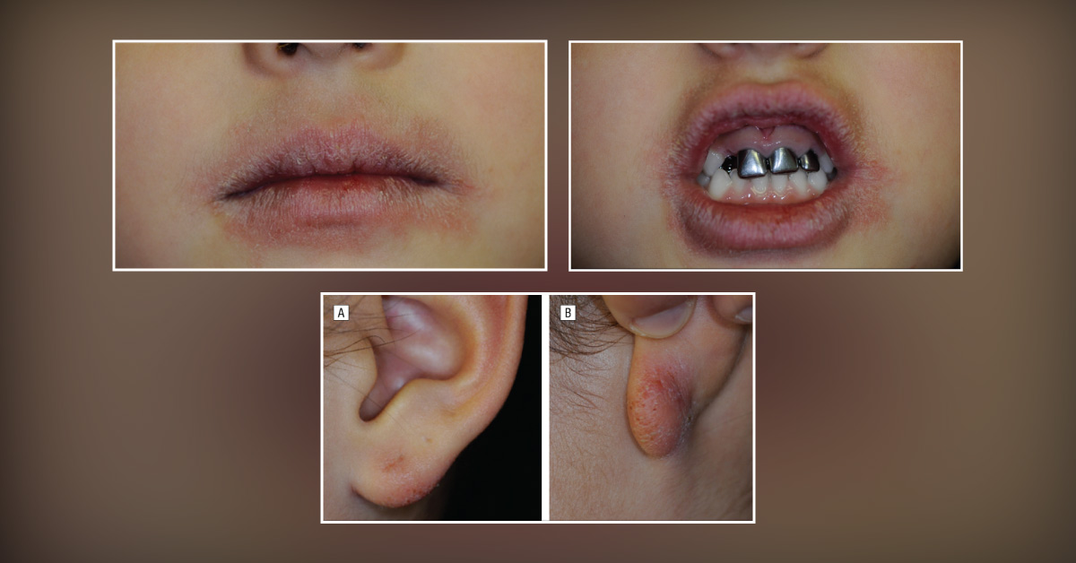 Case of a Young Girl with Itchy and Tender Perioral Skin