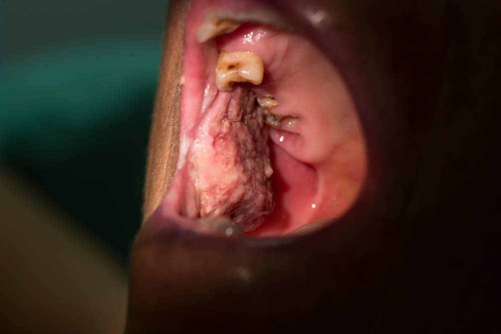 In 6 Years, Oral Cancer Cases Rise By 114% In India: Study