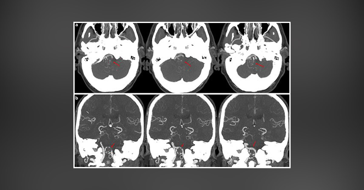 Diagnose This Man with Difficulty in Swallowing Food