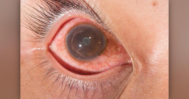 Syndromes Associated With Uveitis