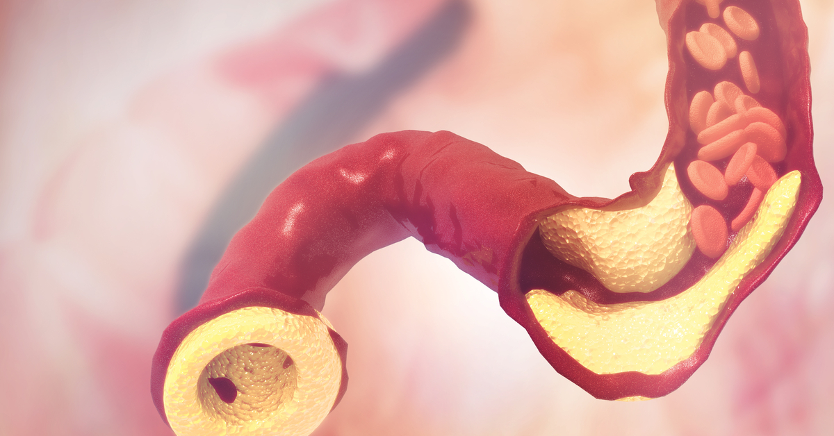 Muted Responses To The New AHA/ACC Cholesterol Guidelines– The Politics Of Guidelines!